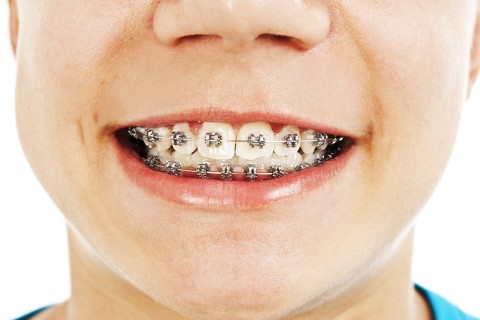 Çocuklarda Ortodontik Tedavi - Diş Teli